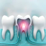 kill tooth pain nerve in 3 seconds permanently